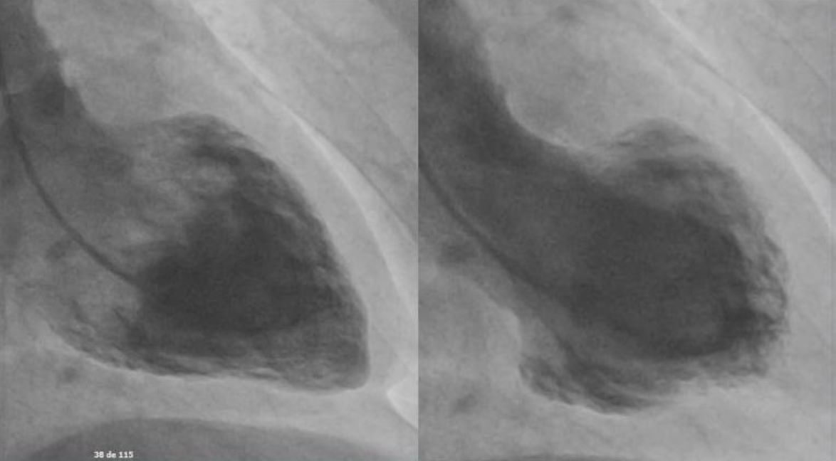 Figura 2. Ventriculografia comparando diástole e sístole, com padrão sugestivo de TAK médio-ventricular.